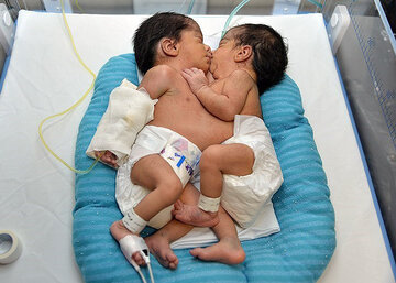 عملية فصل شقيقتين أهوازیتین ملتصقتین في مستشفى نمازي بشيراز
